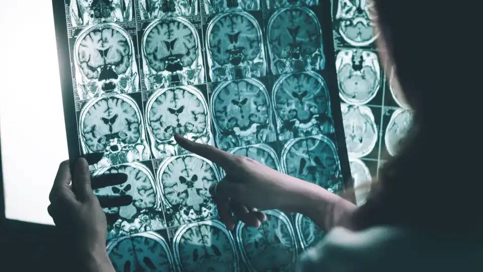 alzheimer